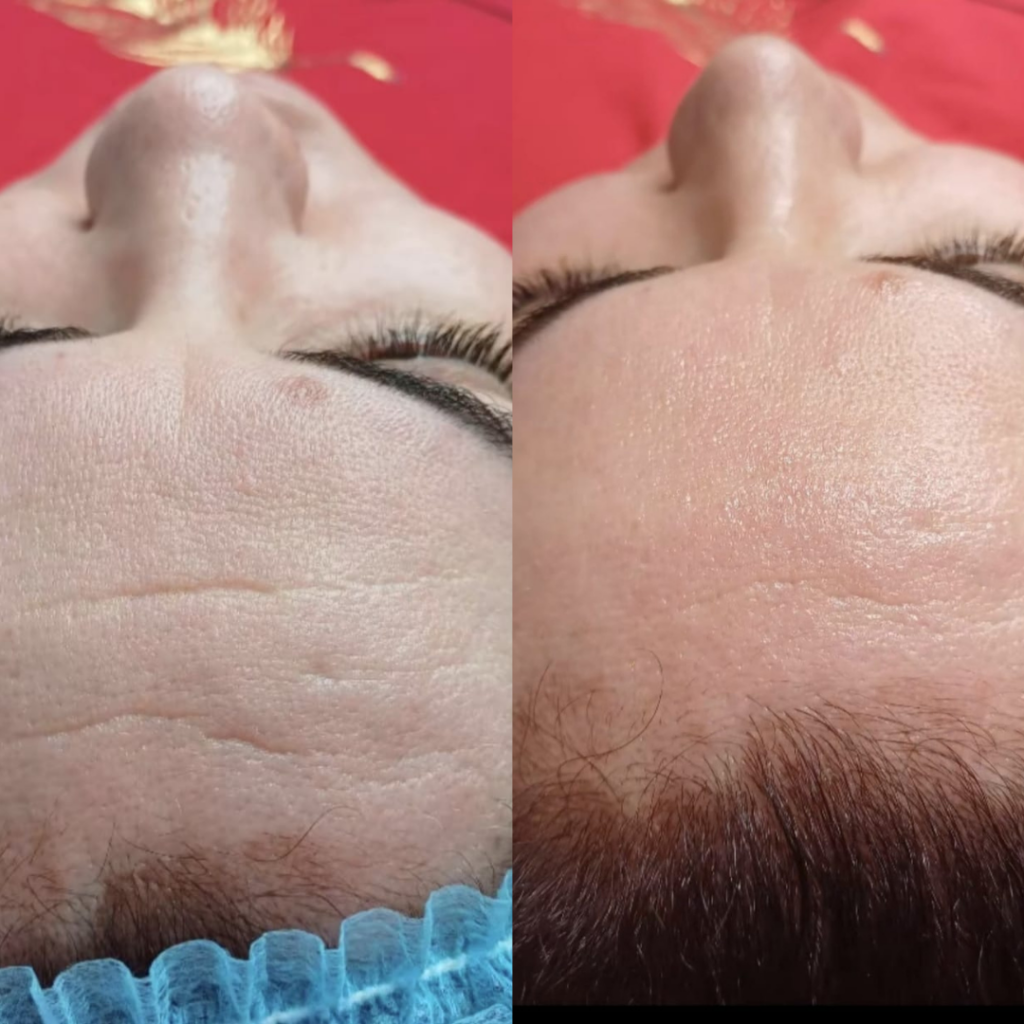 Comparaison avant-après d'épilation du dos pour homme avec peau lisse et cils visibles sur les yeux fermés